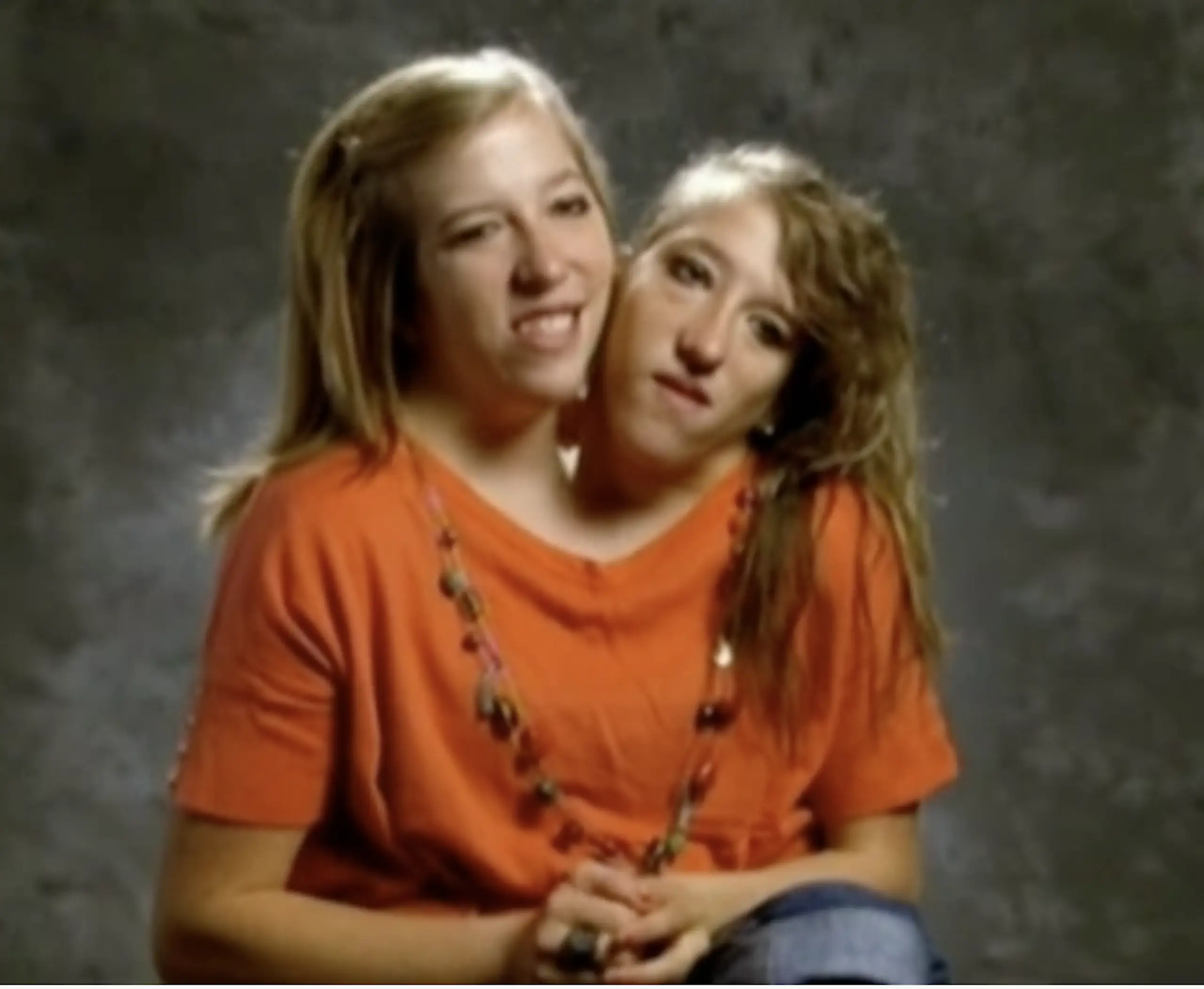 Abby and Brittany are one of the only sets of dicephalus twins. Credit: BBC